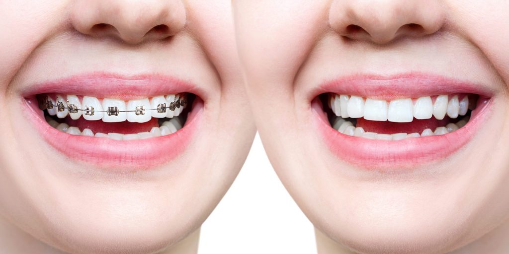 invisalign teeth treatment