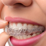Invisalign treatment