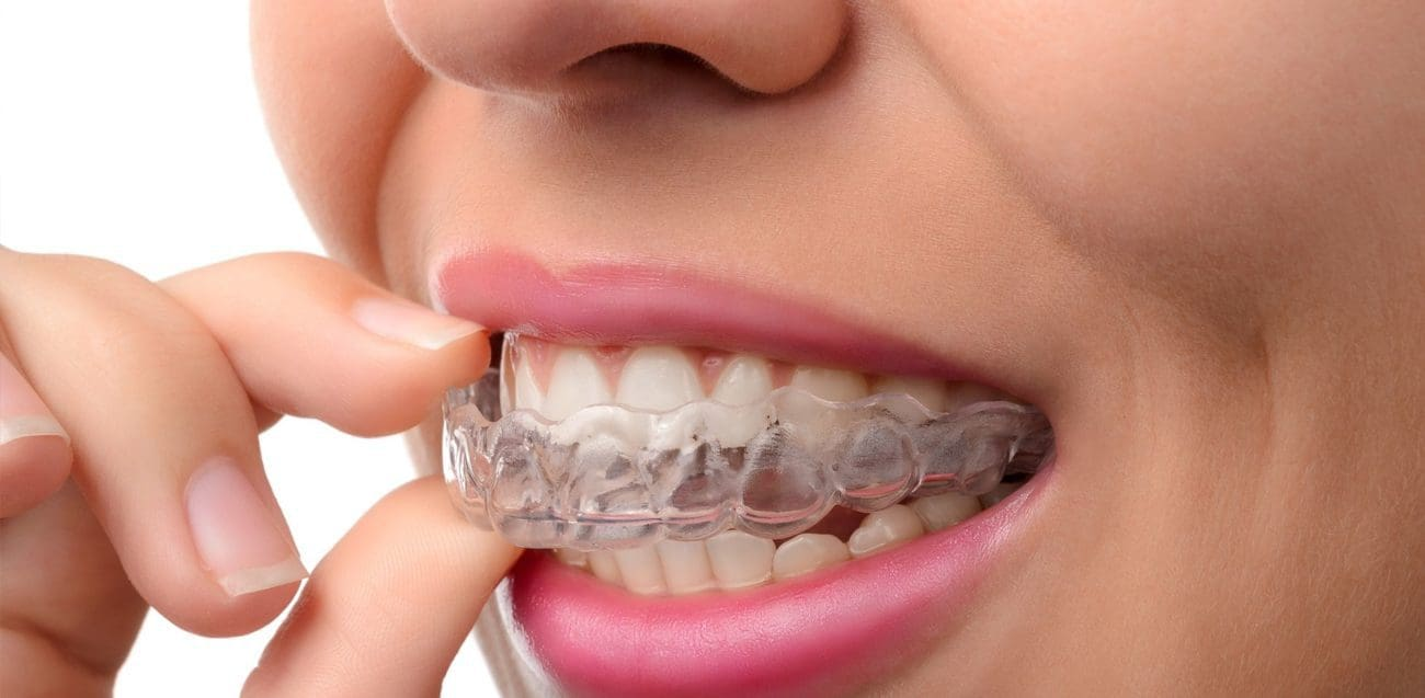 Invisalign treatment